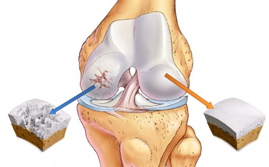 The knee joint is joint joint