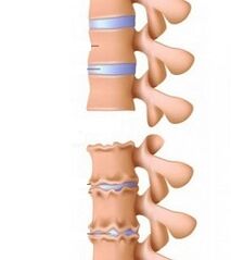 Sections of ramps of osteochondrosis of the neck