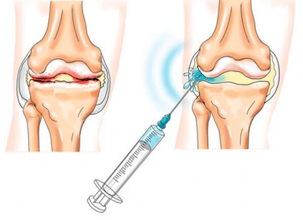intraarticular injections for knee arthrosis